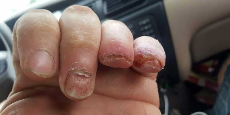 Shortened fingers of Jimmy Carr of the Niagara Devils after radial arm saw injury.